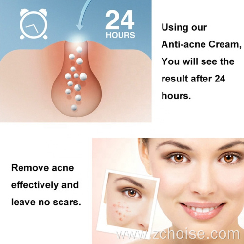 tea tree acne cream pimples remover cream